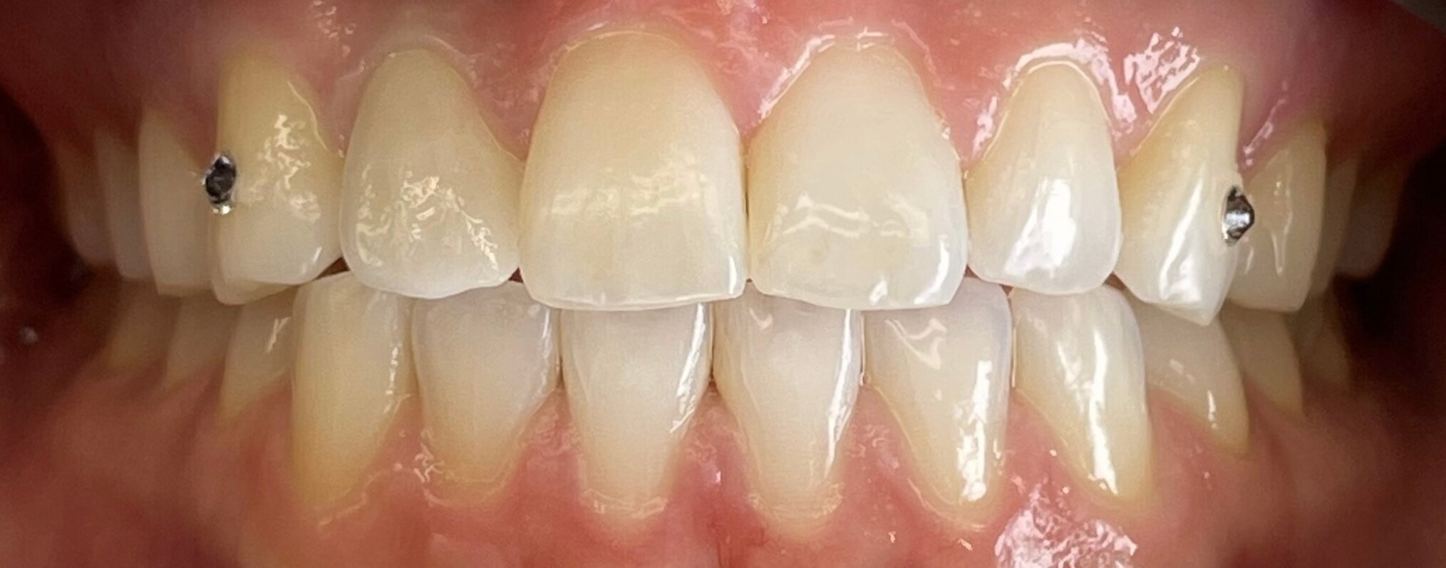 Dental Implants by Kelowna Dental Centre - After