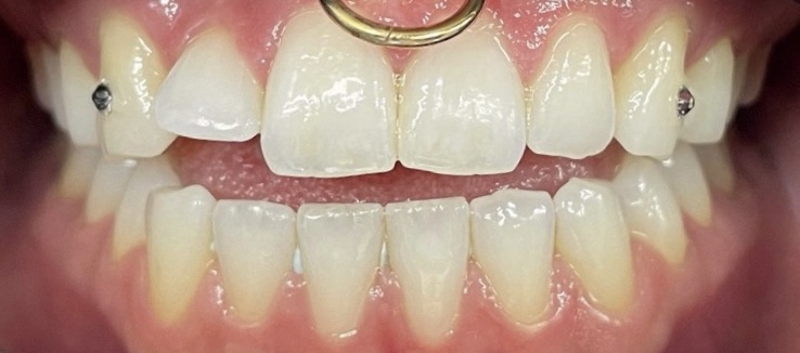 Dental Implants by Kelowna Dental Centre - Before