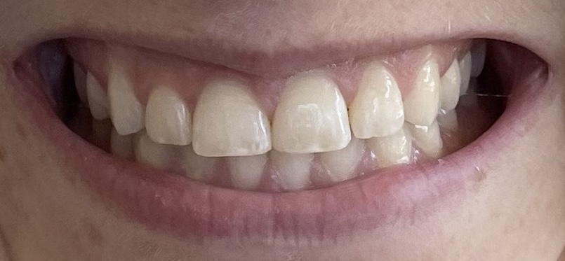 Veneers by Kelowna Dental Centre - Before