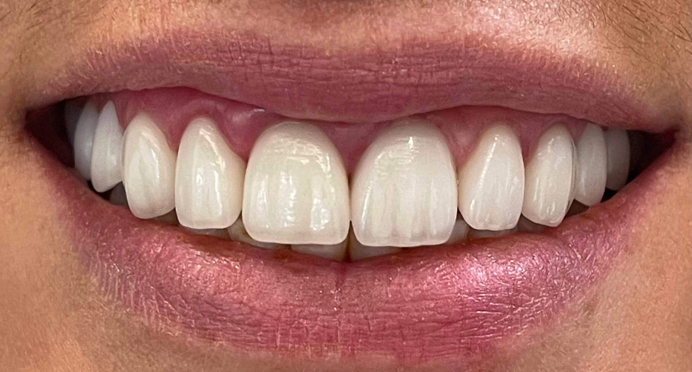 Veneers by Kelowna Dental Centre - After