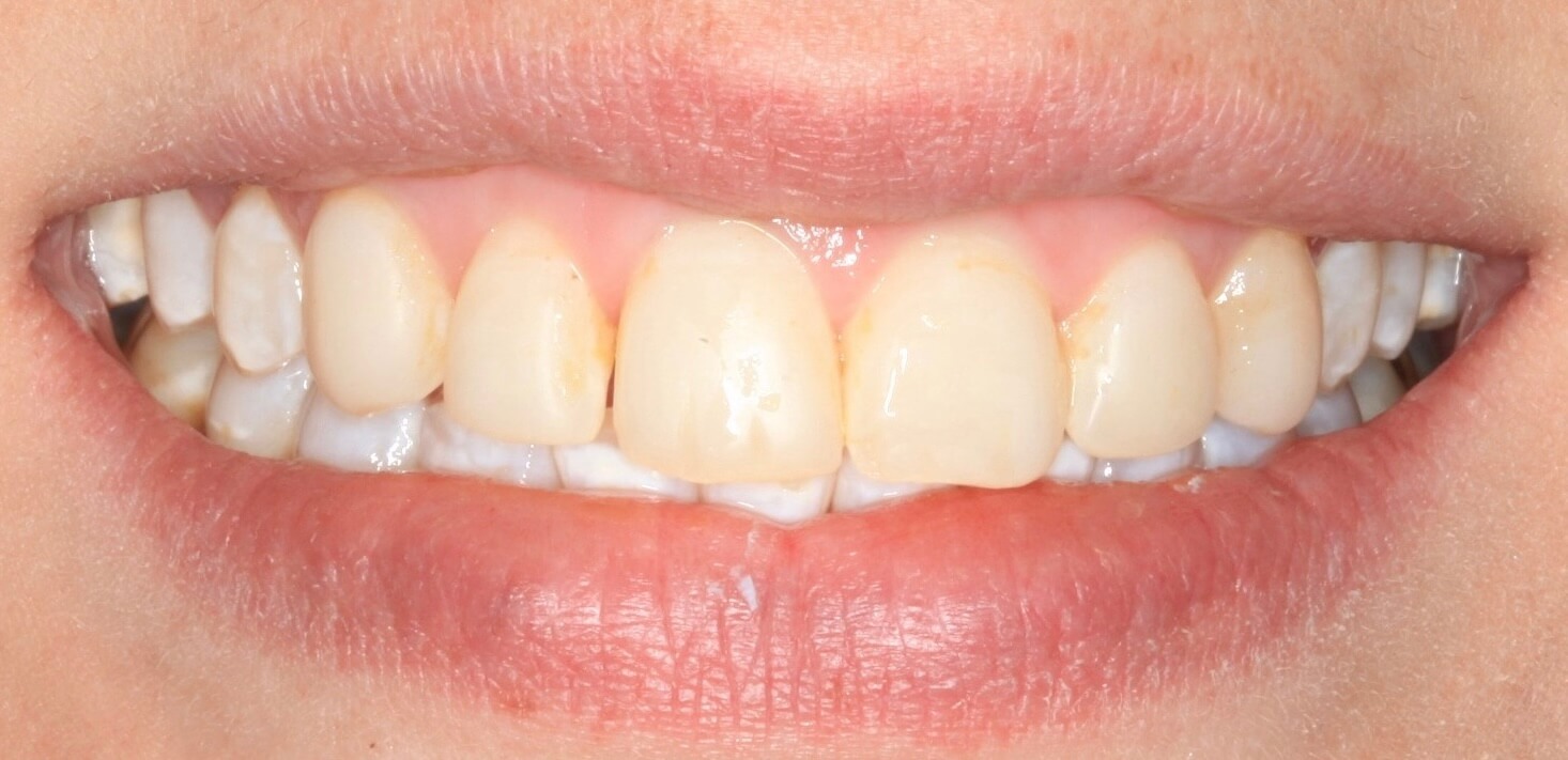 Veneers by Kelowna Dental Centre - Before