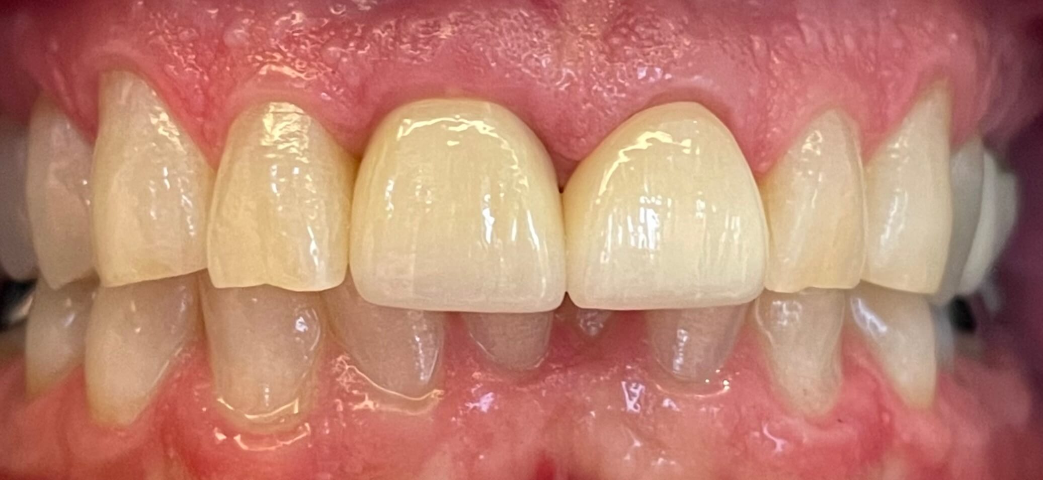 Dental Implants by Kelowna Dental Centre - After