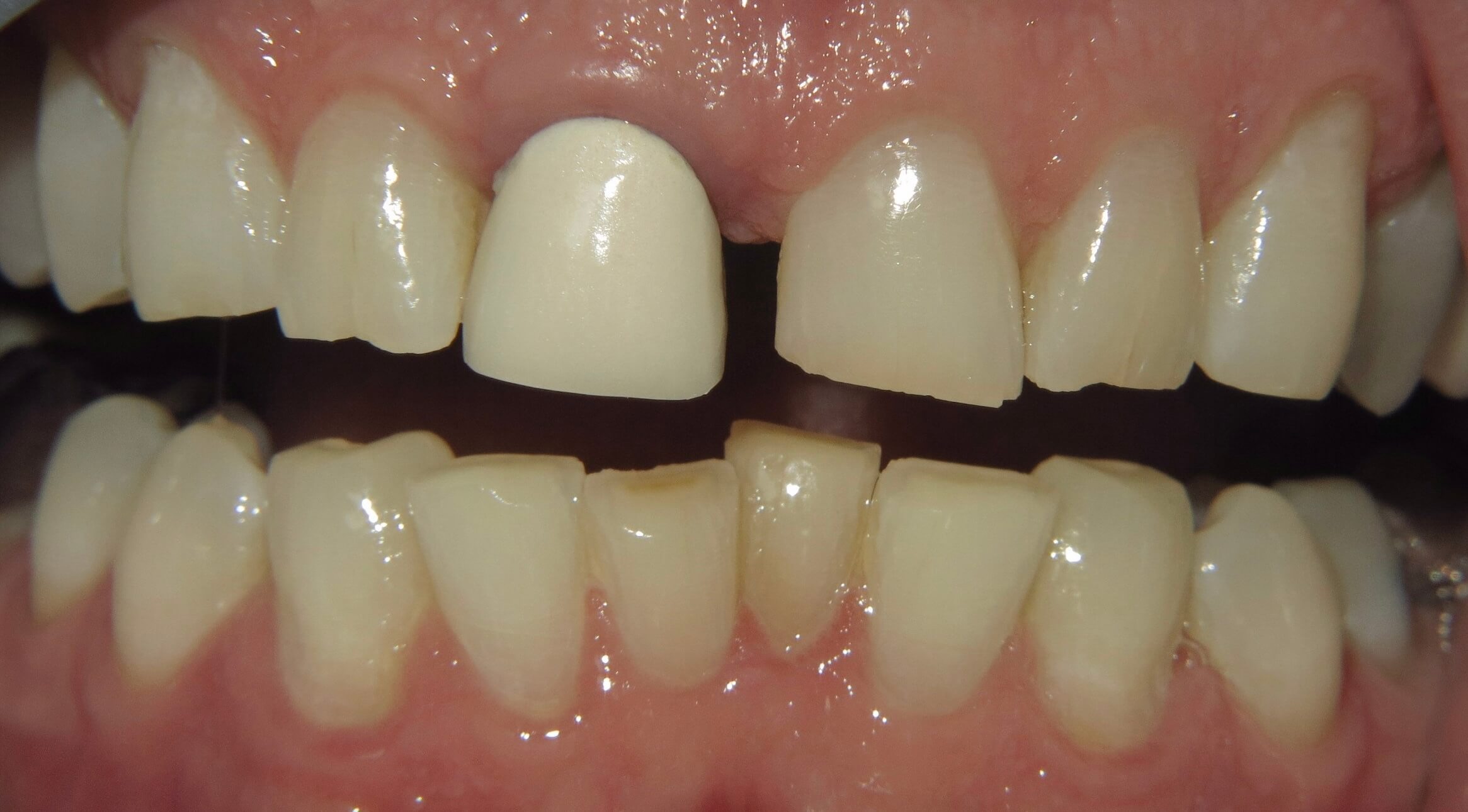 Dental Implants by Kelowna Dental Centre - Before