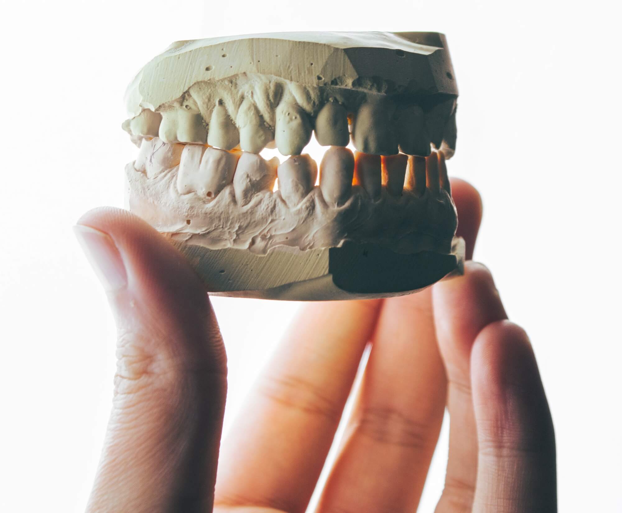 Smile Makeover and Full Mouth Reconstruction