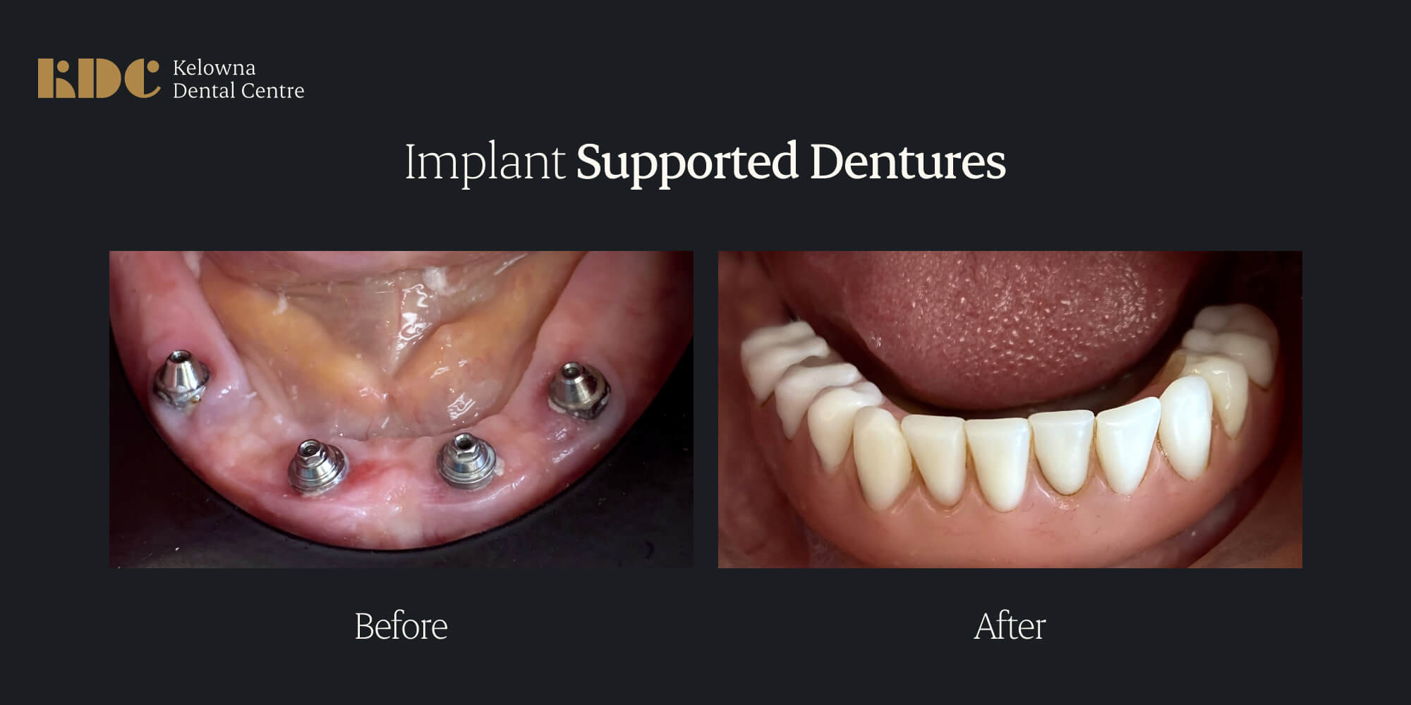 Implant-Supported Dentures Before and After