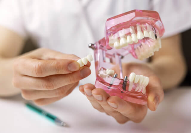 Implant-supported dentures at Kelowna Dental Centre