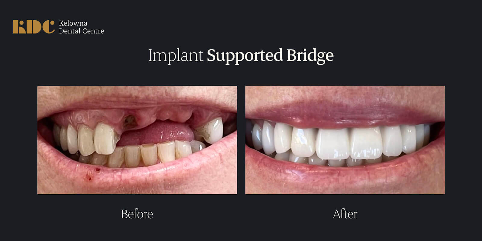 This patient came to us because she was told for many years that she could not have implants placed in the front due to a lack of bone. She was completely done with wearing a denture. Fortunately, our team was able to make her dream come true by placing an implant-supported bridge.