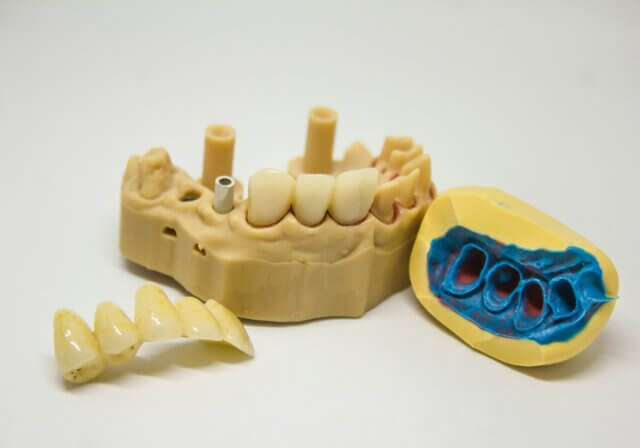Types of dental implants