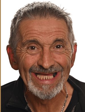 Andy Miller before dental implants - Kelowna Dental Centre