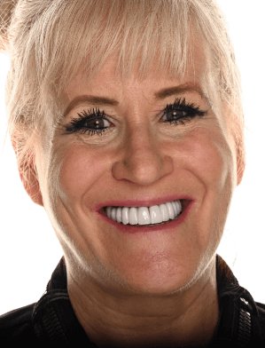 Cindy after New Teeth Today dental implants