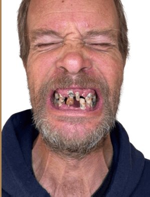 Damien before dental implants - Kelowna Dental Centre