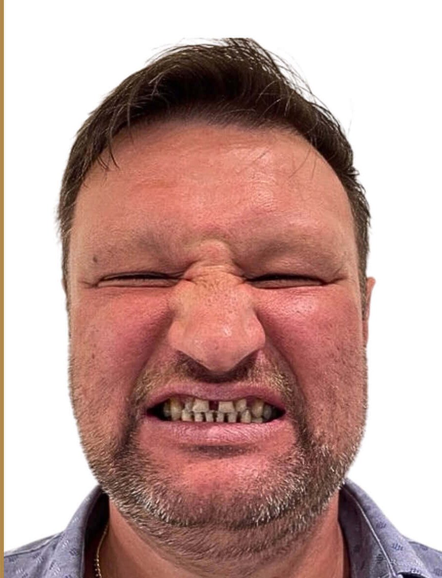 Johann before dental implants - Kelowna Dental Centre