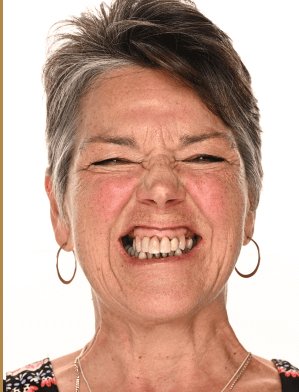 Karin Koehle before dental implants - Kelowna Dental Centre
