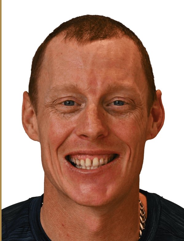 Steve Clark before dental implants - Kelowna Dental Centre