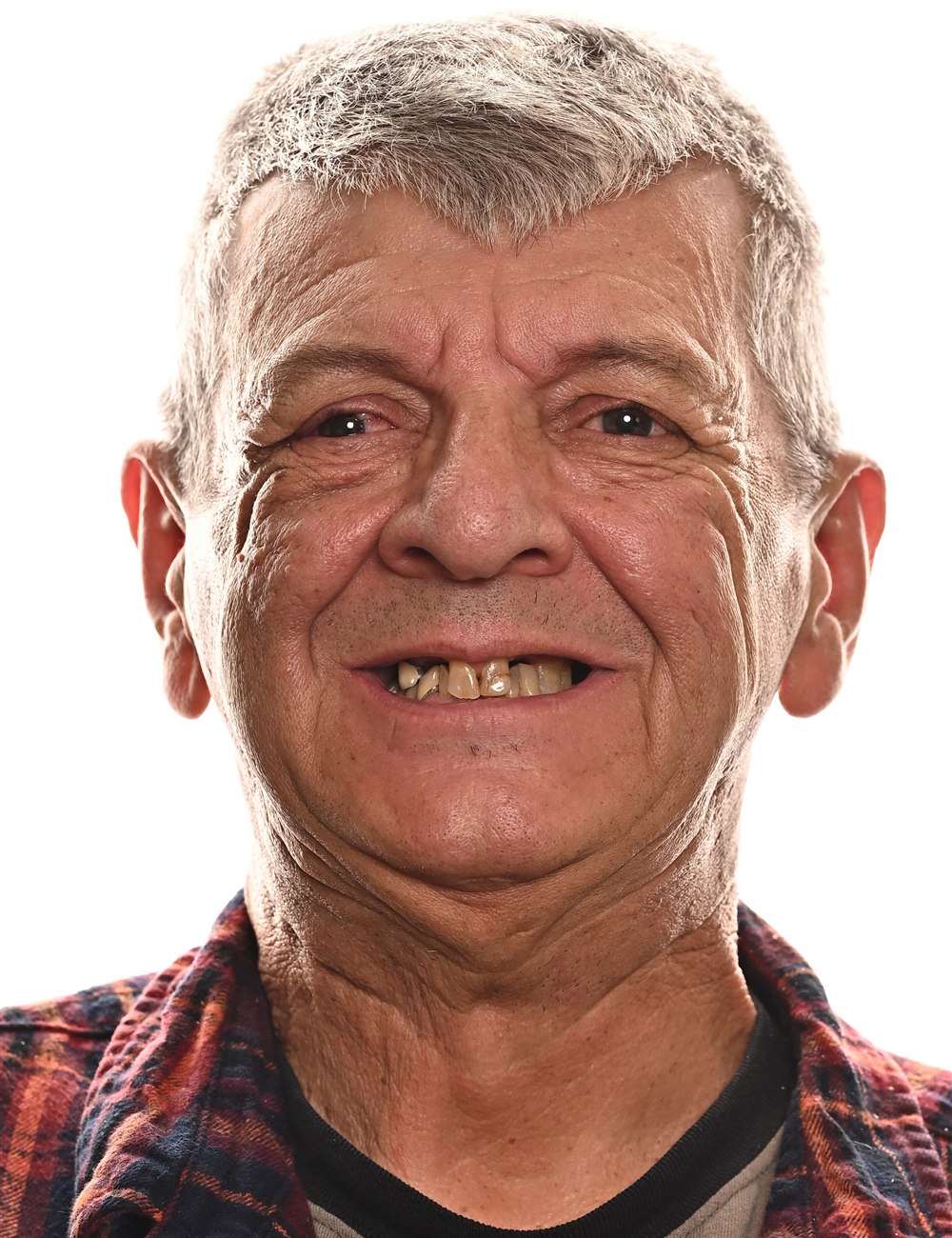 Lee Rieger before dental implants - Kelowna Dental Centre