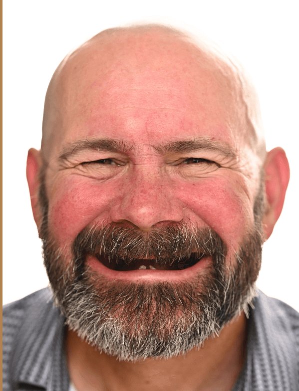 Roary McFadden before dental implants - Kelowna Dental Centre